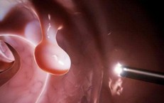 Đa polyp túi mật có nguy hiểm không?