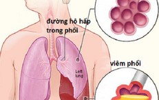 5 cách giúp chủ động phòng ngừa viêm phổi khi chuyển mùa