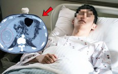 Chạy bộ kiểu này, người đàn ông bất ngờ tử vong vì vỡ khối ung thư gan