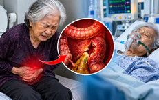 Tự thụt tháo vì táo bón, cụ bà 81 tuổi vỡ đại tràng, nguy kịch
