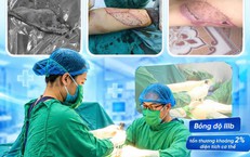Ghép da cho bệnh nhân bỏng bô xe máy