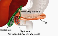 Sỏi túi mật khi nào cần mổ cấp cứu?
