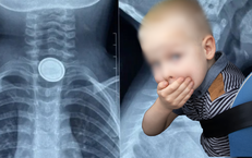 Bé 3 tuổi nuốt pin cúc áo, thực quản bị ăn mòn nghiêm trọng