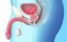 Phì đại tuyến tiền liệt ở nam giới lớn tuổi khi nào cần điều trị?