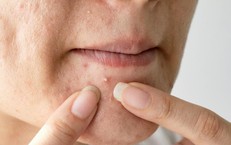 5 cách giảm nguy cơ để lại vết thâm sau mụn trứng cá