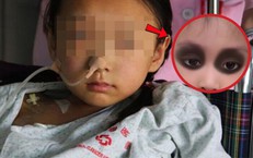 Mắt bé gái 4 tuổi chuyển màu tím vì ung thư, mẹ hối hận vì điều này