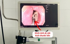 Lấy xương gà kích thước lớn mắc kẹt trong thực quản bệnh nhân