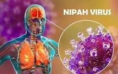 Bộ Y tế hướng dẫn giám sát và phòng bệnh do virus Nipah ở người