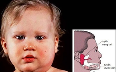 Bệnh quai bị bao lâu thì khỏi?