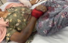 Tự chữa sau khi bị rắn độc cắn, một phụ nữ ở Lâm Đồng nguy kịch