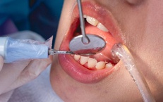 Những ai cần thận trọng khi lấy cao răng? 