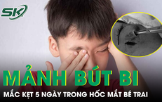 Gắp đoạn bút bi nhựa mắc kẹt 5 ngày trong hốc mắt bé trai