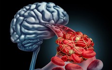 Dị dạng mạch máu: Dấu hiệu nhận biết và mức độ nguy hiểm không thể chủ quan