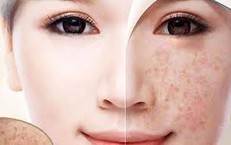 Nhận diện thủ phạm gây đốm đồi mồi trên da