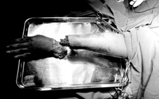 Nỗ lực giữ lại bàn tay công nhân bị dập nát do tai nạn lao động