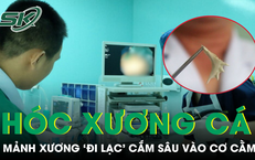 Phẫu thuật lấy xương cá 'trú ẩn' 10 ngày trong cằm bệnh nhân
