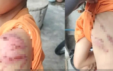 Công an điều tra vụ bé trai nghi bị cha ruột đánh