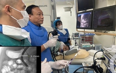 Sỏi ống mật chủ 'khủng' gây tắc mật nặng