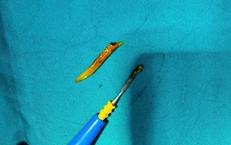 Nam bệnh nhân nhập viện cấp cứu vì xương cá kích thước lớn 'đi lạc' xuống... ruột non