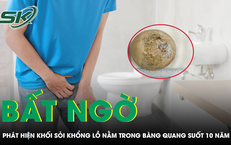 Phát hiện sỏi bàng quang khổng lồ khi bệnh nhân đi khám bệnh khác