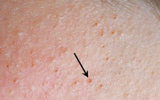 Viêm nang lông có tự khỏi không?