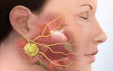 U tuyến mang tai có biểu hiện như thế nào?