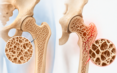 8 cách tăng mật độ xương, giảm nguy cơ loãng xương và gãy xương