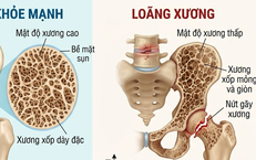 Phòng loãng xương cần hạn chế 5 loại thực phẩm này