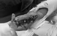 Tai nạn trong tích tắc vì pháo nổ, nam thanh niên suýt mất chức năng bàn tay
