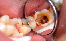 5 biện pháp tự nhiên giảm triệu chứng sâu răng