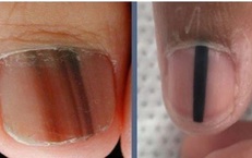Sọc sẫm màu trên móng tay, móng chân là biểu hiện của bệnh gì?
