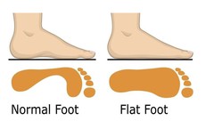 Bàn chân bẹt ở trẻ em có cần điều trị không?