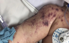 Sở Y tế An Giang xác nhận trẻ tử vong ở Phú Quốc do viêm não mô cầu