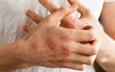 Ảnh hưởng lên da của bệnh đái tháo đường, dấu hiệu không nên bỏ qua