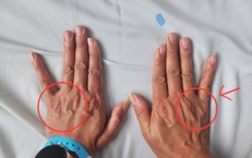 Tê ngón út kéo dài, người đàn ông suýt teo cơ bàn tay