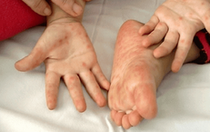 Trẻ mắc tay chân miệng rồi có mắc lại nữa không?