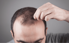 5 loại dầu dưỡng tự nhiên tốt nhất cho nam giới bị hói đầu