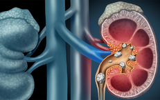 Sỏi san hô nguy hiểm nhận biết ra sao?