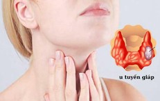 Dược thiện cho tuyến giáp: 5 nhóm thực phẩm bổ trợ và những loại cần kiêng kỵ