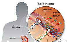 Loại thuốc trị đái tháo đường mới vừa kiểm soát đường huyết, vừa hỗ trợ giảm cân