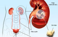 Cách phòng ngừa sỏi thận không dùng thuốc