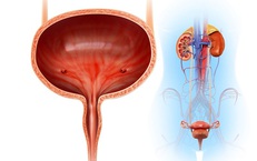 Thói quen xấu gây sỏi bàng quang