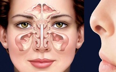 Đau hốc mắt kéo dài, coi chừng viêm xoang trán