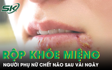 Chủ quan với loét miệng thông thường, người phụ nữ chết não sau vài ngày