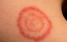 Cảnh giác nấm da lây từ chó, mèo