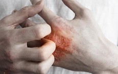 Bí quyết kiểm soát và phòng ngừa eczema hiệu quả