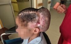 Đột quỵ sau cấy mỡ tự thân, nữ bệnh nhân phải tái tạo hộp sọ