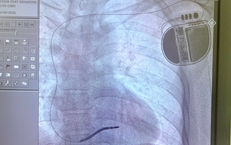Người đàn ông 3 lần ngất, 1 lần ngưng tim, nguy cơ đột tử cao được cứu nhờ kỹ thuật lần đầu triển khai