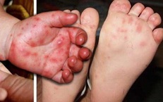 Tay chân miệng ở Khánh Hòa tăng gấp 4 lần năm ngoái, bác sĩ khuyến cáo điều phụ huynh cần làm ngay