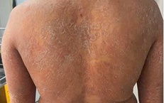 Dùng sai thuốc, nấm da lan toàn thân, ngứa dữ dội